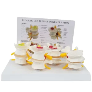 4 Stage Lumbar Vertebrae Degeneration Model Human Spine Model