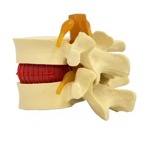 lumbar disc compression pathology Medical tool accessories manual tools
